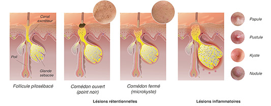 Différents types d'acne