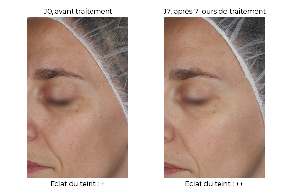 Visualisation de l’effet de REVILIENCE<sup>®</sup> sur l’éclat du teint de volontaires jeunes